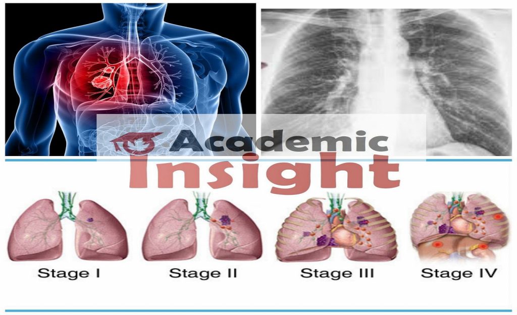 What are the symptoms of Lung Cancer.