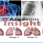 What are the symptoms of Lung Cancer.