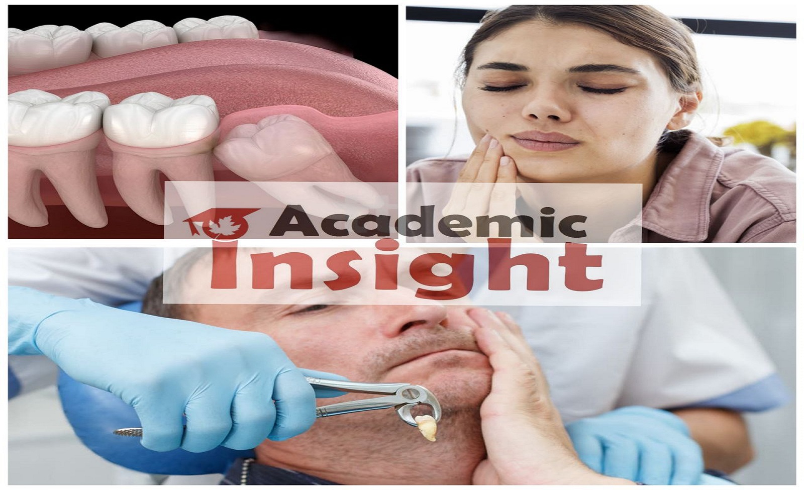 Wisdom tooth removal, what to expect
