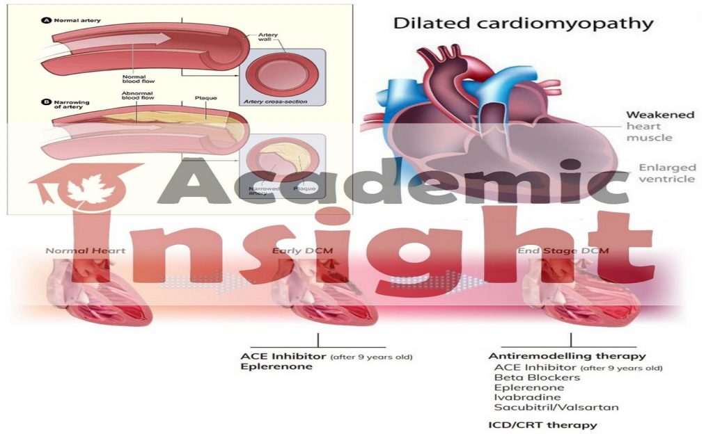 The outlook for ischemic cardiomyopathy and how to prevent